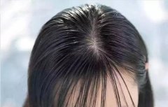 头发变的格外油腻怎么回事