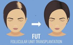 脱发治疗一般要花多少钱才能治疗好？