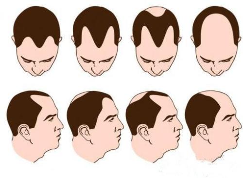 有一个遗传性脱发的父亲，会遗传给儿子吗？