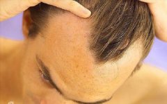 为什么大多数的男性都是头顶脱发