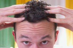 病理性脱发会出现什么明显症状？