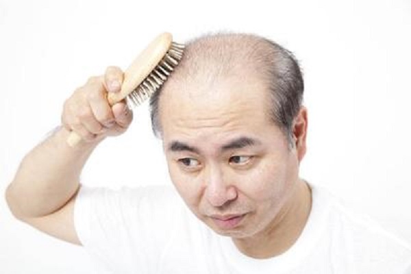 什么方法能够防止男性脱发