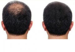 头发纤维粉，让我变得更自信