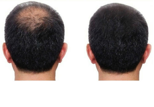 苏玫氏头发纤维粉