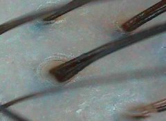 什么情况下毛囊会坏死