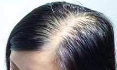 脂溢性脱发可以通过植发治疗吗？