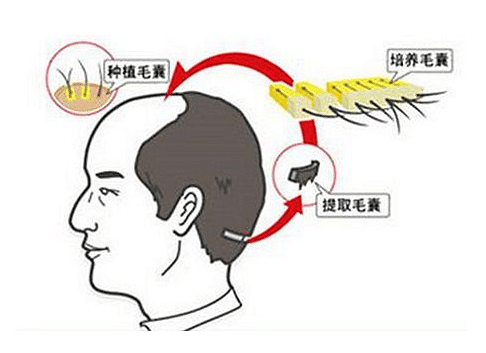 植发后都有什么注意事项