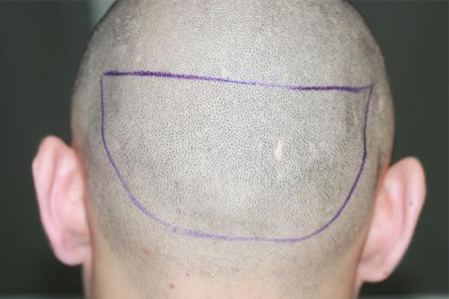 植发后的取发区应该怎么护理