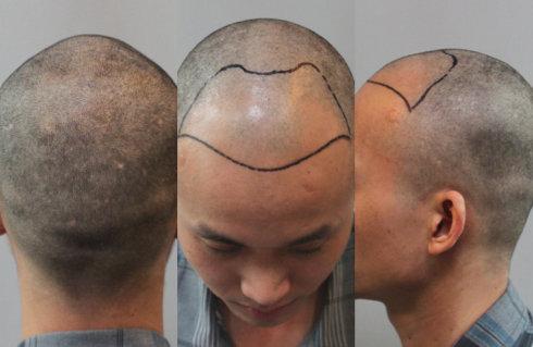  植发后，植发区应该怎么正确护理