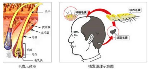   植发之前为什么要做毛囊检测