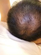 增发纤维让我的头发变密了