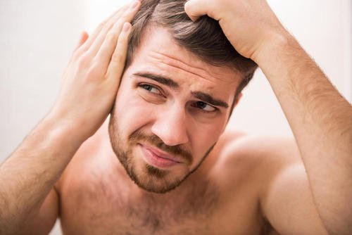男性雄性脱发的特征