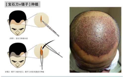 植发时毛囊的成活率高吗？