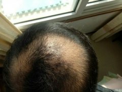 增发纤维帮助我恢复了原本的形象