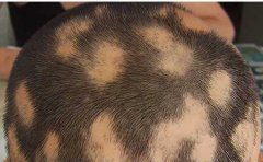 导致斑秃都有什么因素？