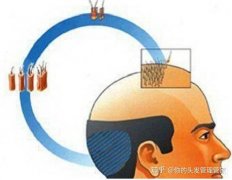 哪些因素能够保证植发手术的效果