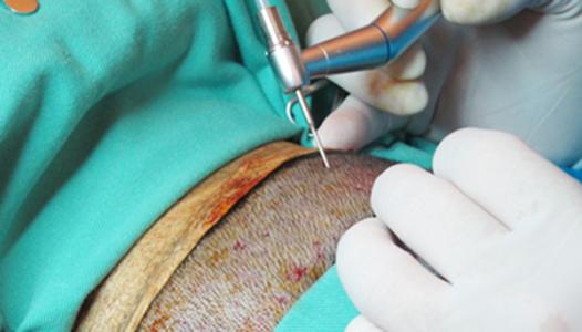 植发会造成的危害有哪些