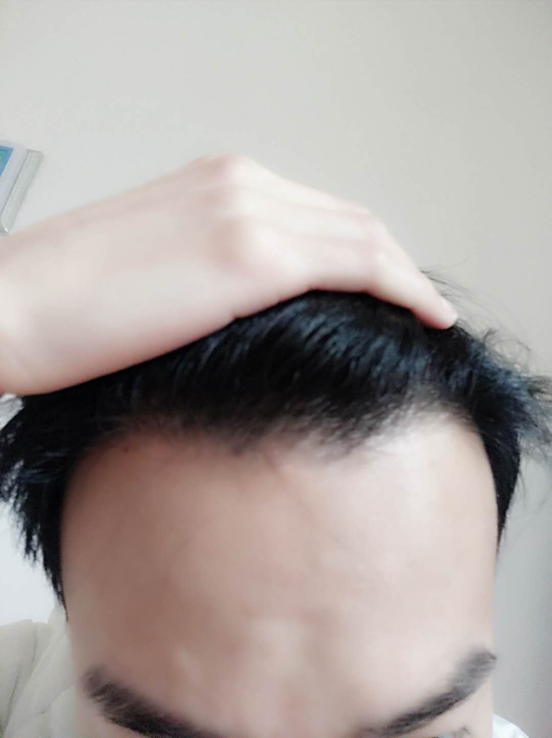 北京植发际线一年效果，给你一个植发的理由 - 知乎
