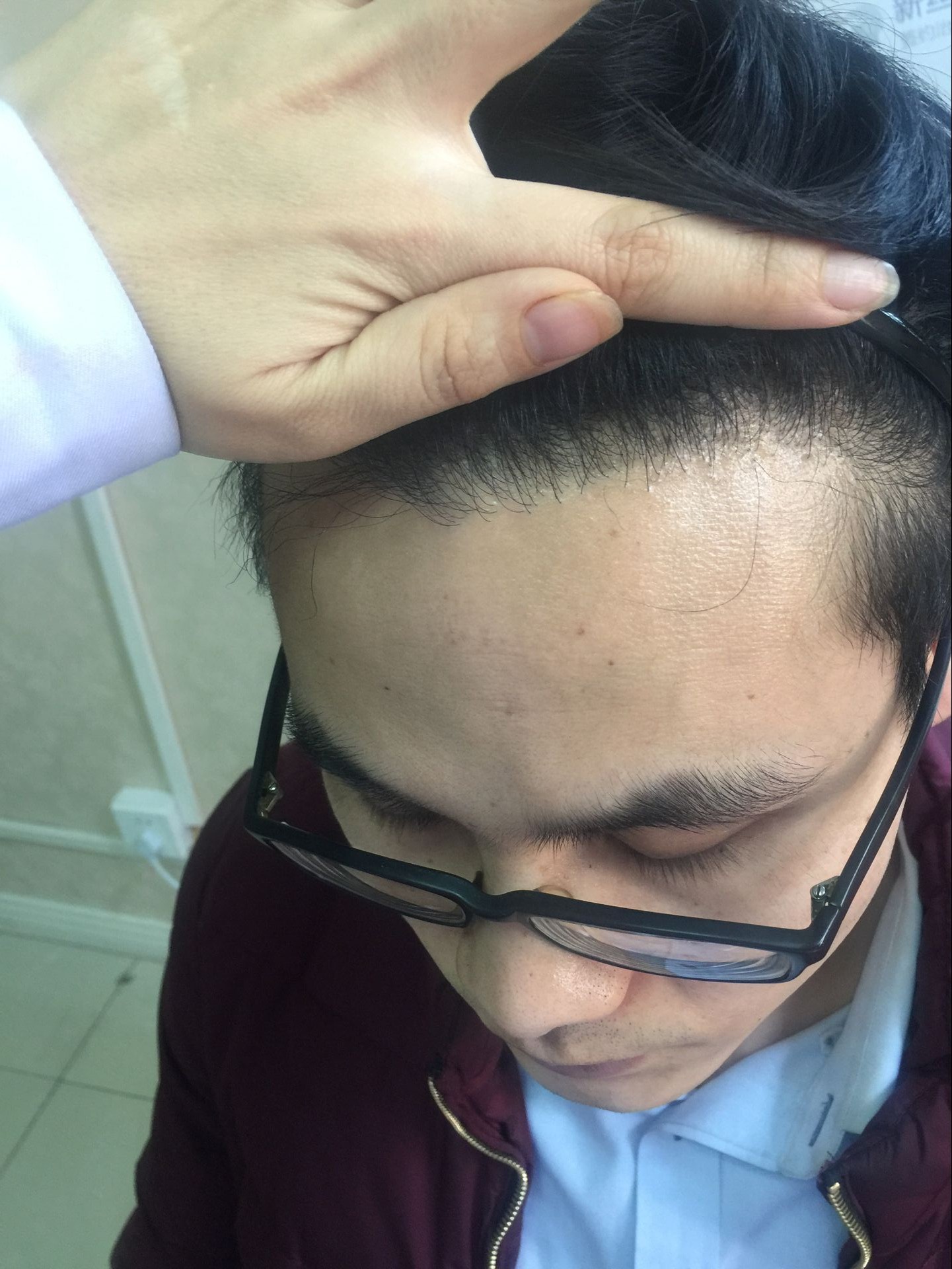 盘点上海九院做植发比较知名的医生！（附植发案例对比图）-发友网