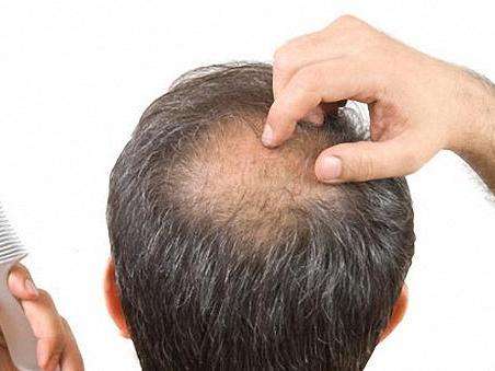 影响男性脱发的因素有哪些