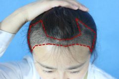 发际线后移怎么办？