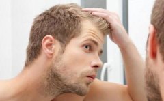 为什么男性很容易患上脂溢性脱发