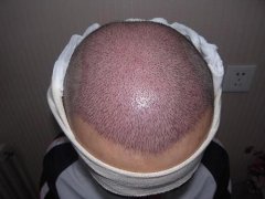 什么时候植发最合适