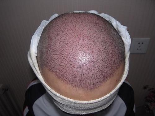 什么时候植发最合适