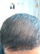 增发纤维真的能让我头发增多吗