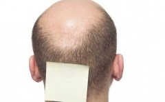 男性脱发最常见的误区
