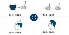 植发手术很疼吗