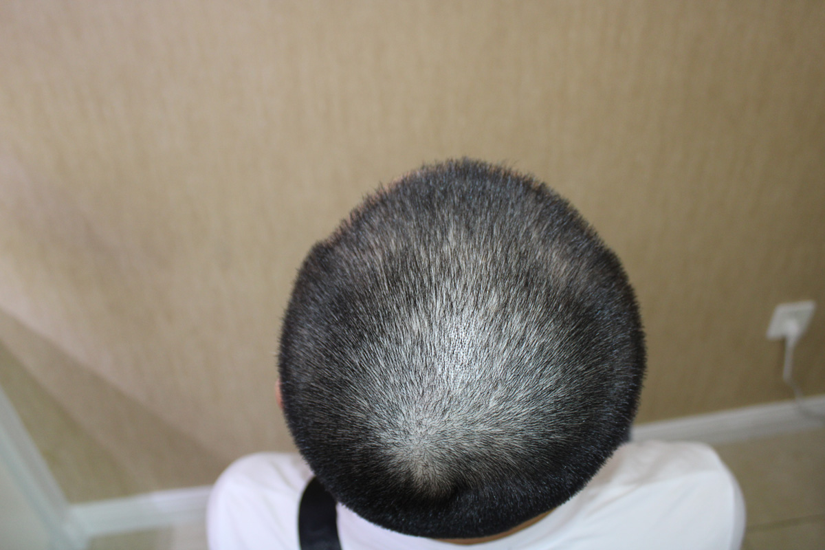 种植发际线多久能长出新头发呢？ - 知乎