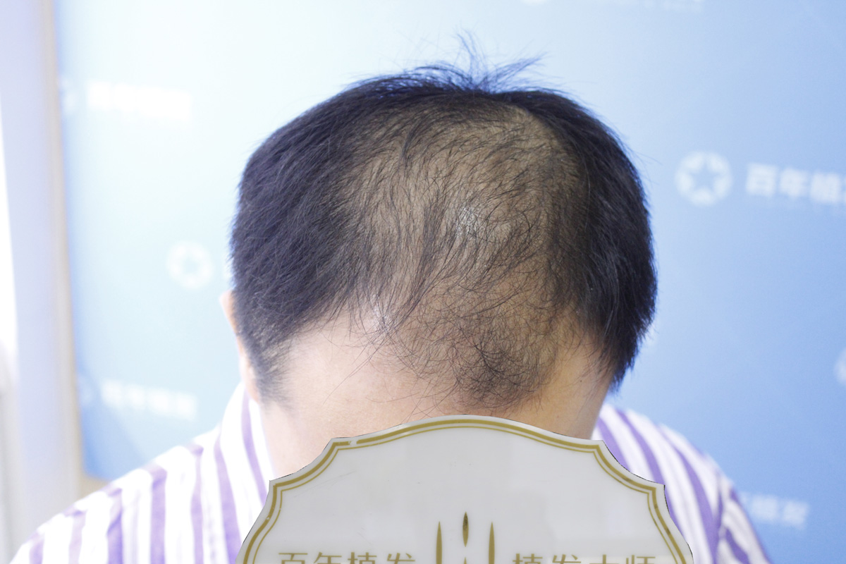 男士头顶稀疏 ，大面积加密植发，植发术后即刻效果 - 哔哩哔哩