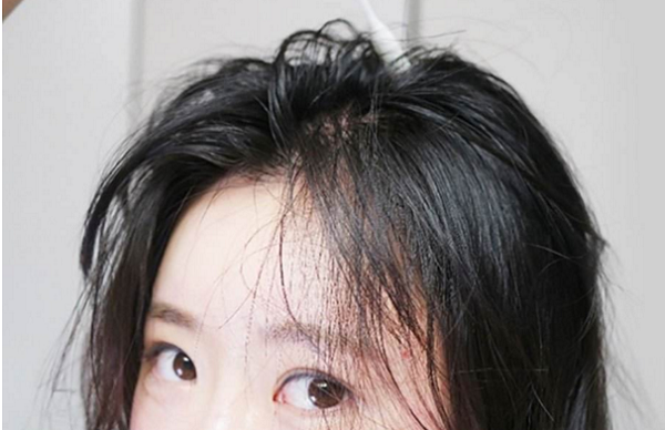 女性脱发前的预兆有哪些?