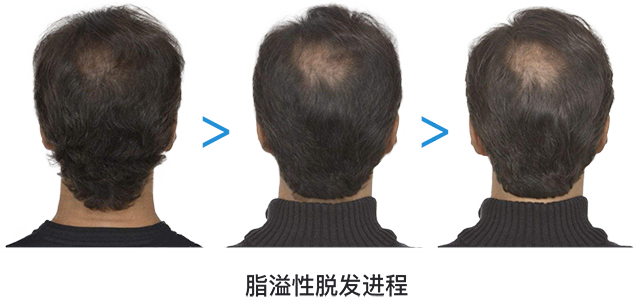 脂溢性脱发一定是油性发质吗?