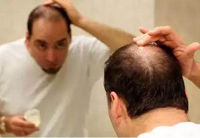 男性脱发的早期症状和误区