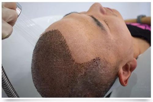 哪些脱发类型可以做植发手术