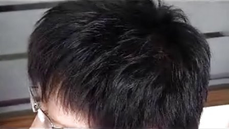 溢脂性脱发