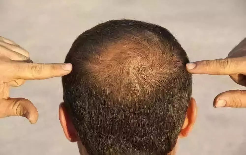 脂溢性脱发
