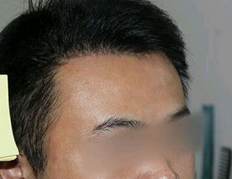 脂溢性脱发