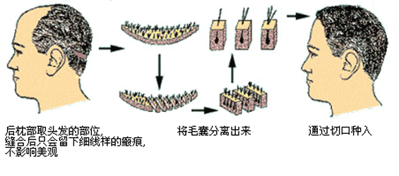 头部的疤痕植发成功率高吗