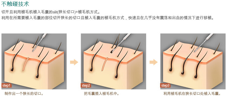 植发效果