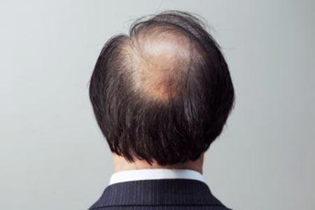 男性脱发与肾虚有关吗？