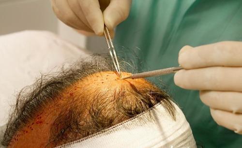 治疗男性脱发的可靠方法有哪些