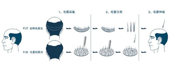 FUE与FUT植发(fut植发和fue植发的区别)
