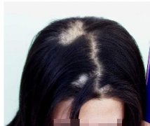 什么原因會造成斑禿