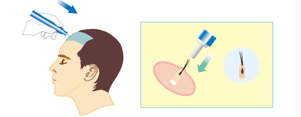 植发手术的原理