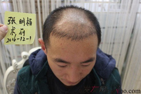 我在上海大麦微针植发后，6个月的效果经历