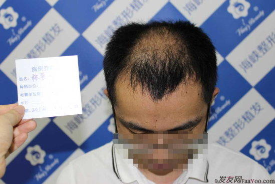 济南植发案例3500单位效果完美,来看我的植发日记