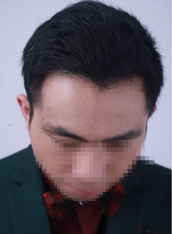 济南植发案例3500单位效果完美,来看我的植发日记